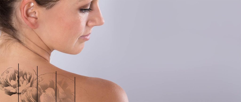 Tattoo-Removal-Treatment
