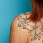 Laser-Tattoo-Removal-Body